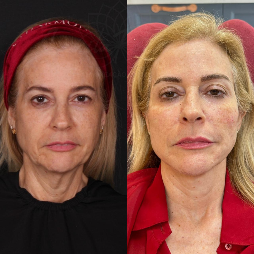 Estética Facial Avançada